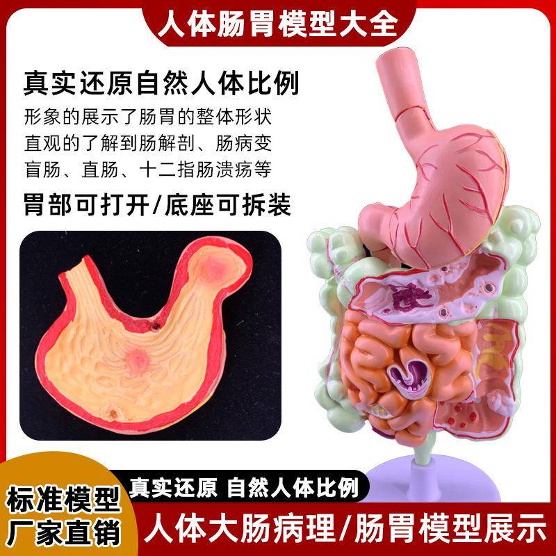人二体大肠病理模型解胃剖模型病态肠大肠盲肠129直肠十指肠模型