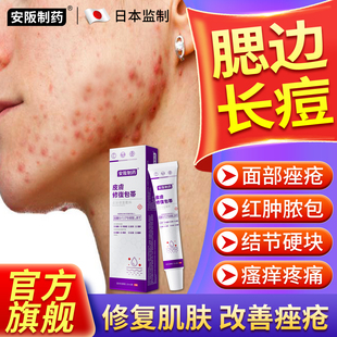 下巴反复长痘专下颚痤疮膏红肿硬块用痘痘淋巴痘腮边痘祛痘药膏sj