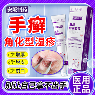 手部角化型湿疹鹅掌风手癣膏专脱皮干裂用皲裂性真菌感染药膏SJ