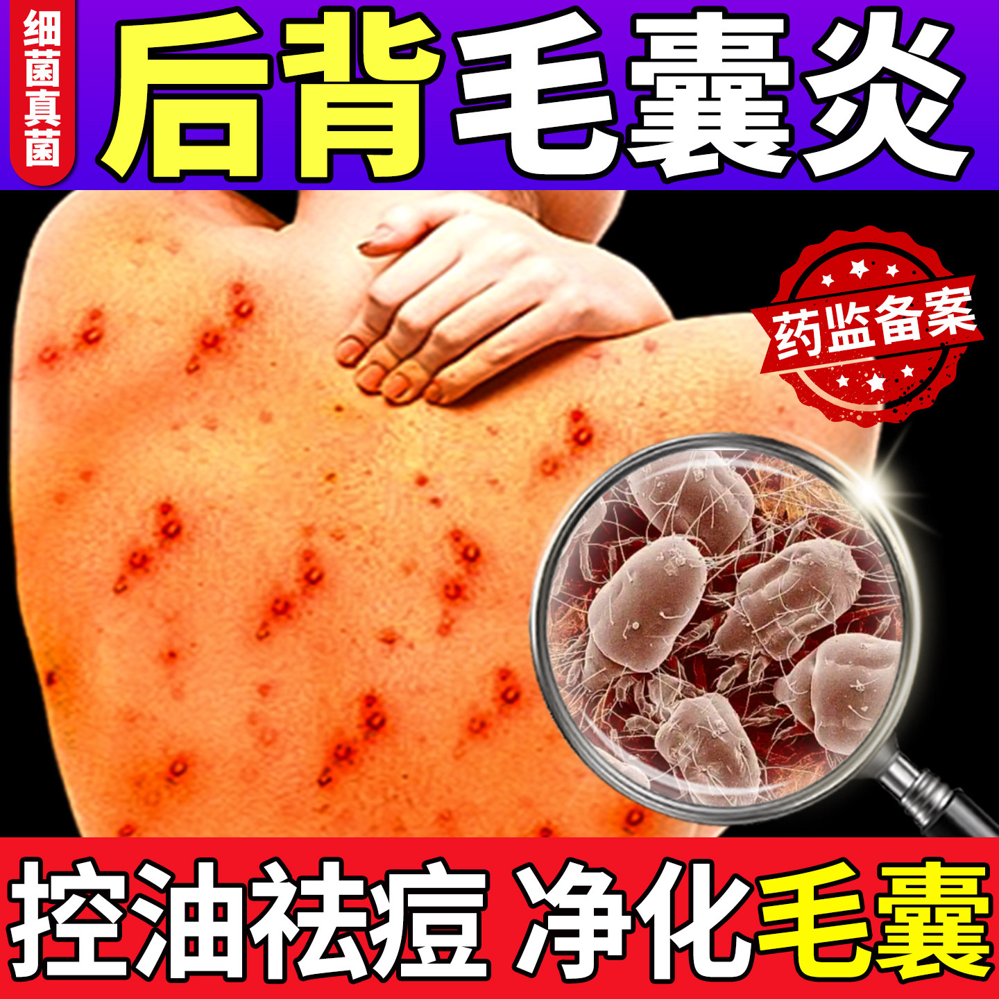 前胸背后背长痘痘痤疮专马拉色菌毛囊炎除螨祛痘痒用药房同售膏sj