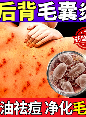 前胸背后背长痘痘痤疮专马拉色菌毛囊炎除螨祛痘痒用药房同售膏sj