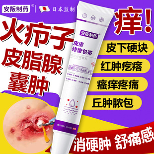 火疖子皮脂腺囊肿粉瘤专拔毒拔脓红肿硬块疙瘩可搭膏药贴用药膏kj