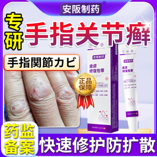 手指关节癣手癣脱皮干裂瘙痒疼痛角化型湿疹鹅掌风真菌感染药膏SJ