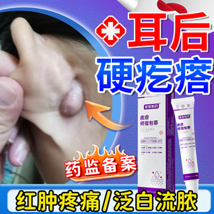 耳后硬疙瘩鼓包粉瘤皮脂腺囊肿拔毒拔脓膏火疖子脓包硬块敷料贴KY