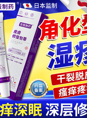 角化型湿疹手癣膏脱皮干裂真菌感染手指皲裂粗糙增厚药膏止痒KY