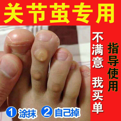 去脚垫老茧厚硬死皮去除膏脚趾关节手茧子专用神器软化剂脚后跟底