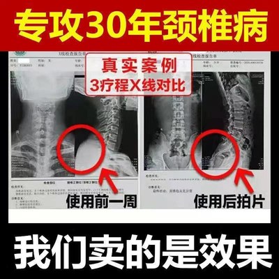 【颈椎克星】手麻脖子僵硬酸痛压迫神经专用头晕疏通经络疼痛贴