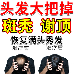 严重脱发斑秃全秃谢顶脂溢性脱发掉发头发稀少固肾生发丸治脱发cp
