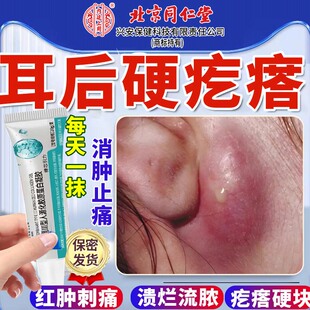 耳垂耳朵后面长疙瘩粉瘤皮脂腺囊肿疖肿硬块拔毒火疖子敷料贴膏YY