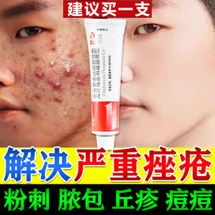 克林霉素磷酸酯凝胶祛痘治疗重度痤疮粉刺痘痘消炎祛痘药膏正品