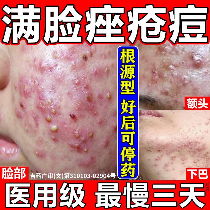 [鉴康]清热暗疮丸60丸/盒