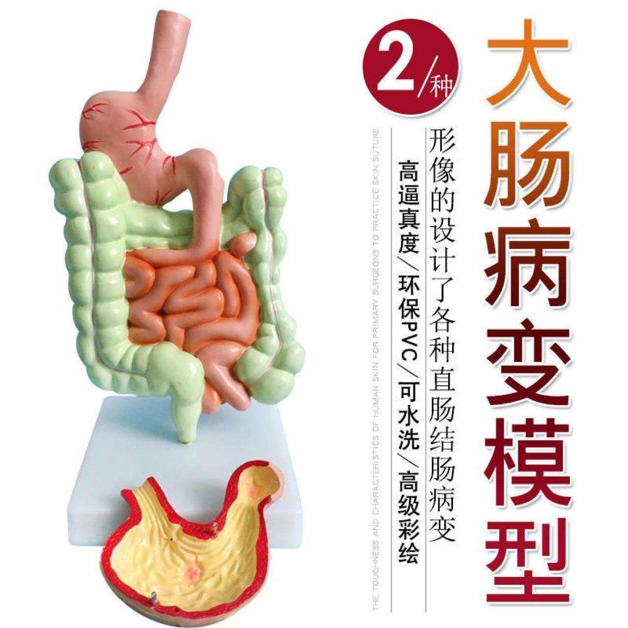 大肠病理模型 肠胃模型 大肠病变模型 肠道疾病 人体结肠病变模型