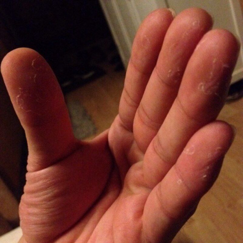 摸摸恢复手脱皮修复霜季节性手掌手指头蜕皮开裂干裂褪起皮掉皮爆