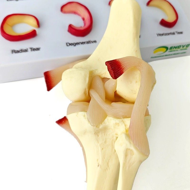人体膝关节半月板 损伤模型运动员半月板磨损形态演示教具标本,文具电教/文化用品/商务用品,教学标本/模型,淘宝优惠券,粉丝福利购,淘宝优惠卷