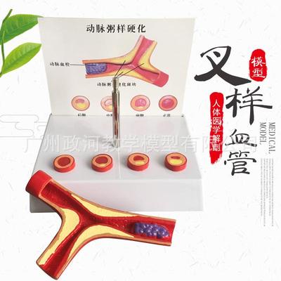 支脉粥样硬化 心血管动脉硬.化模型 血栓.形成模型人体血管模型