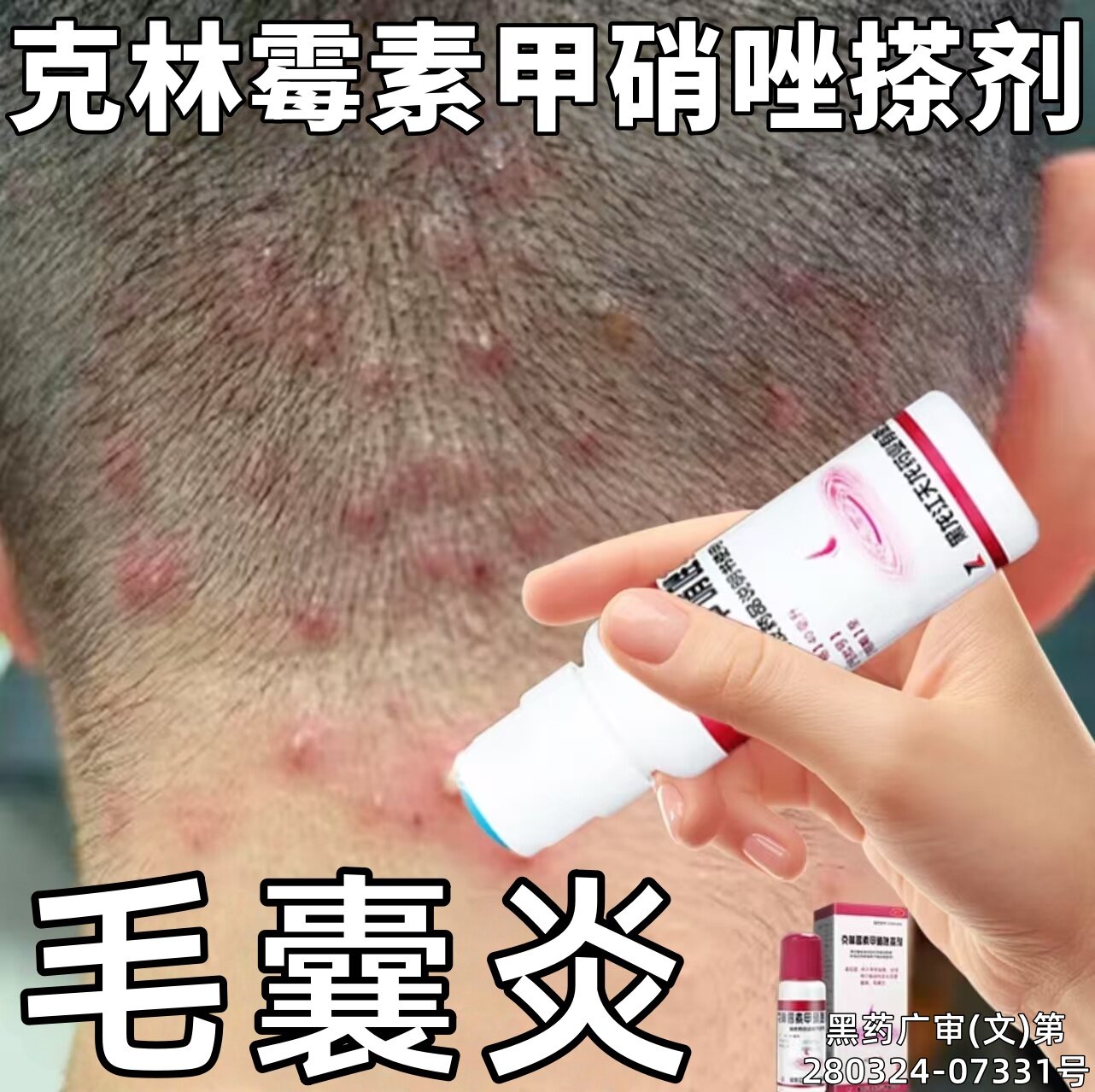 克林霉素甲硝唑搽剂凝胶软膏治疗马拉色菌毛囊炎专用药膏特效pp
