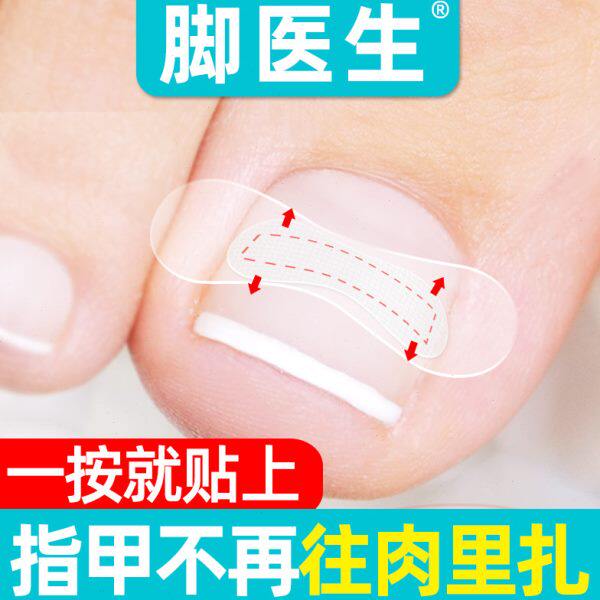 脚医生甲沟嵌甲矫正器炎正甲贴脚趾甲贴片指甲长肉里专用胶水脚沟