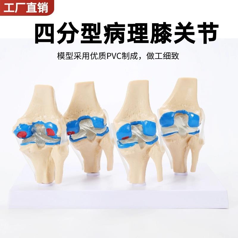 四分型膝关节正常与膝盖骨病变组合模型人骨架模型人体模型