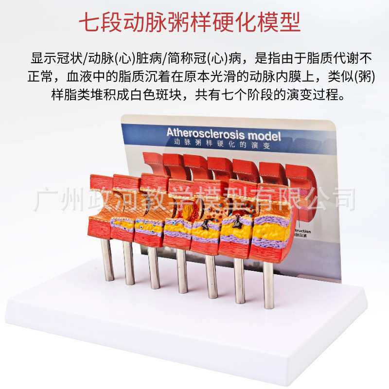 动脉病变硬化模型 动脉血管脂血管堵塞病态血管血管血栓栓塞模型