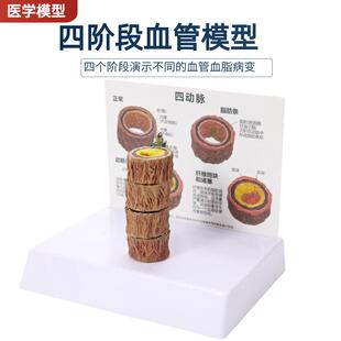 四阶段病理血管人体支脉硬化粥样心血管动脉模型硬化血脂形成模型