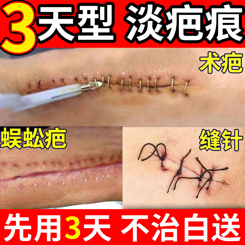 金力康花半伴夏硅酮祛疤凝胶创伤烧烫伤剖腹产疤痕膏正品旗舰店