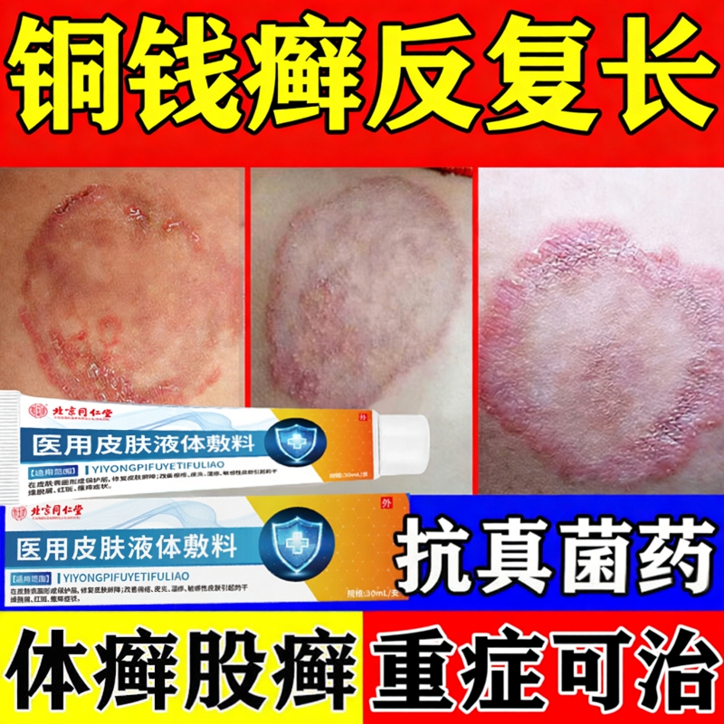 治疗皮藓癣鲜银屑病专手足体股牛头皮肤用药中止特痒效顽固药膏