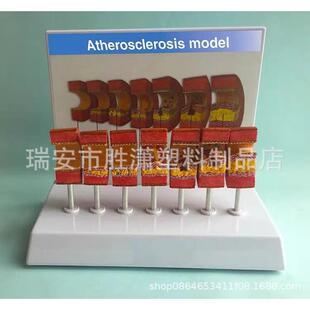 动脉病变硬化模型血管血栓栓塞模型动脉血管脂血管堵塞病态血管
