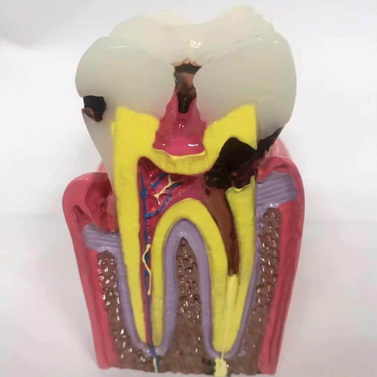 牙881科牙齿沟模6龋齿对比模型口腔型模型医倍患通教学模型包邮立
