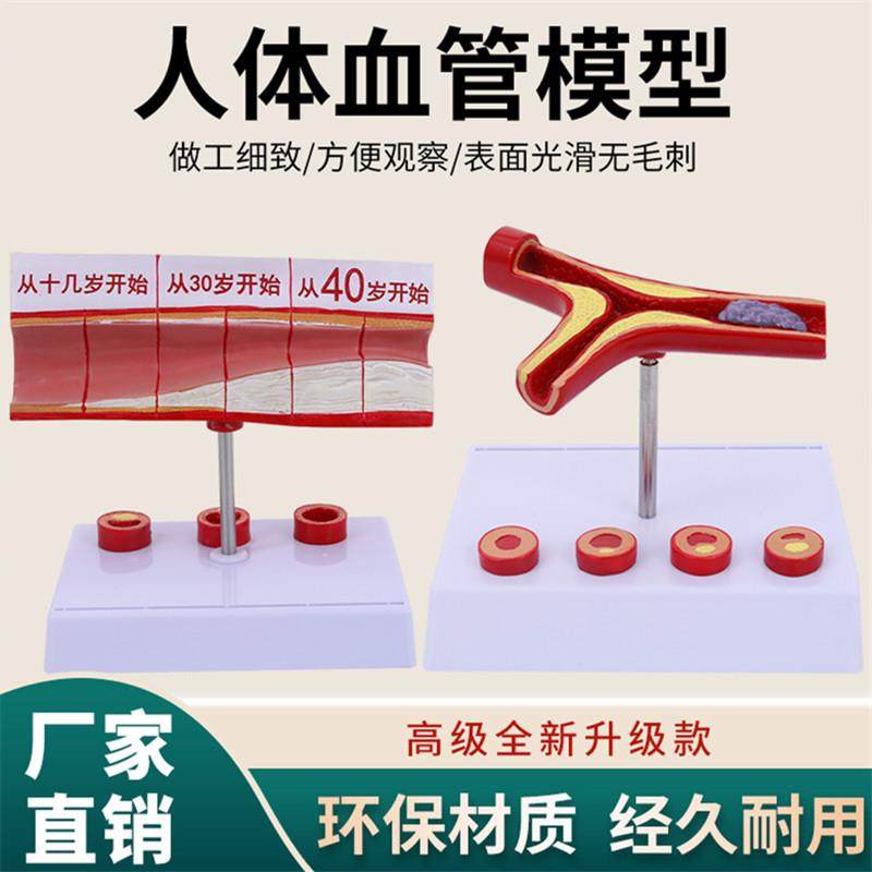 冠状动脉性心血管动脉模型硬化模型老年心脏模型血栓模型