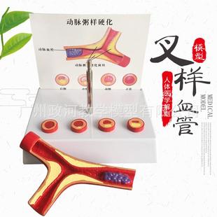 支脉粥样硬化心血管动脉硬.化模型血栓.形成模型人体血管模型
