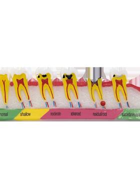 牙齿病理模型蛀牙分类，牙龈牙周受损医患沟通模型FM-B006