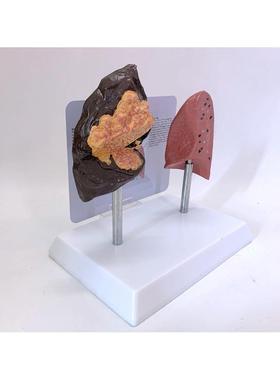 人体吸烟肺与康对比模型病理肺肺健统BQL肺泡解剖肺呼吸系病变肺