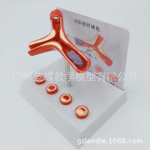 血管/堵塞血液度浓脂957肪病理管血液血管粥样/血模病理解剖型