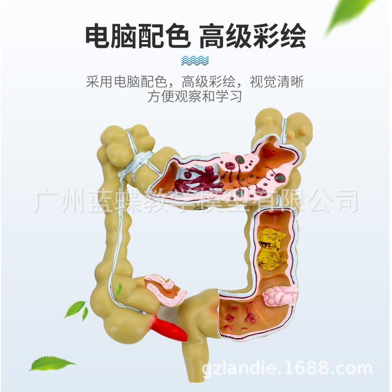 消人体小号肠病变模型肛科消化内科肠大肠无品牌/结模型化科大肠