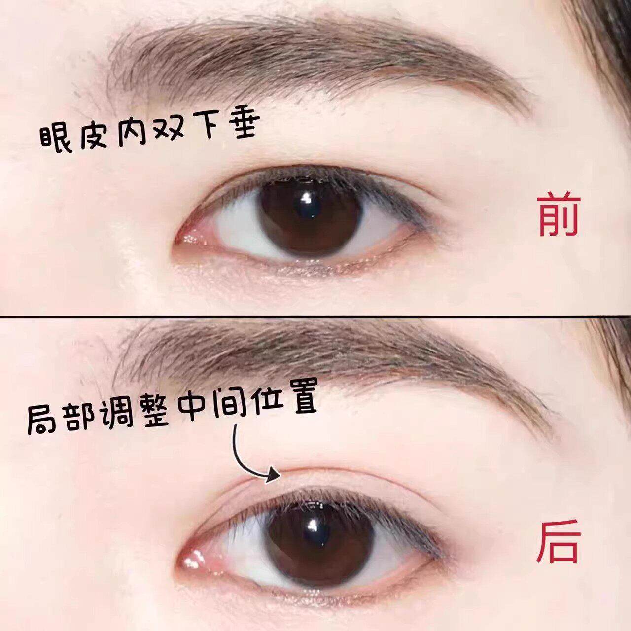 双眼皮隐形自整然无内痕彷真局78736部调透明持久贴定型双单眼皮