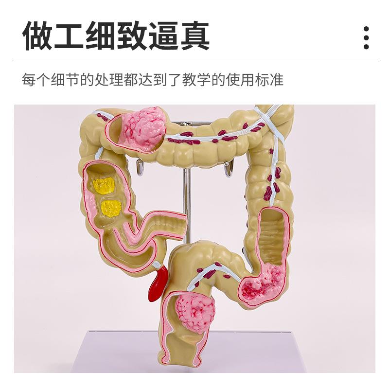 大肠病理模型肠胃模型大肠病变模型肠道疾病人体结肠病变模型