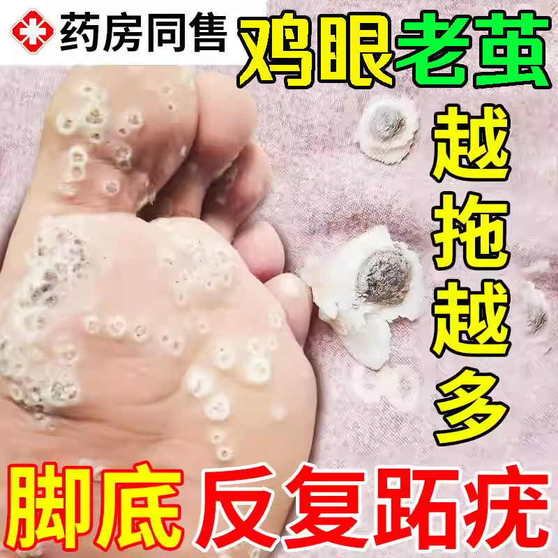 跖疣专用膏去足部脚底趾疣根病疣毒连拔除脚钉祛除膏鸡茧眼药房大