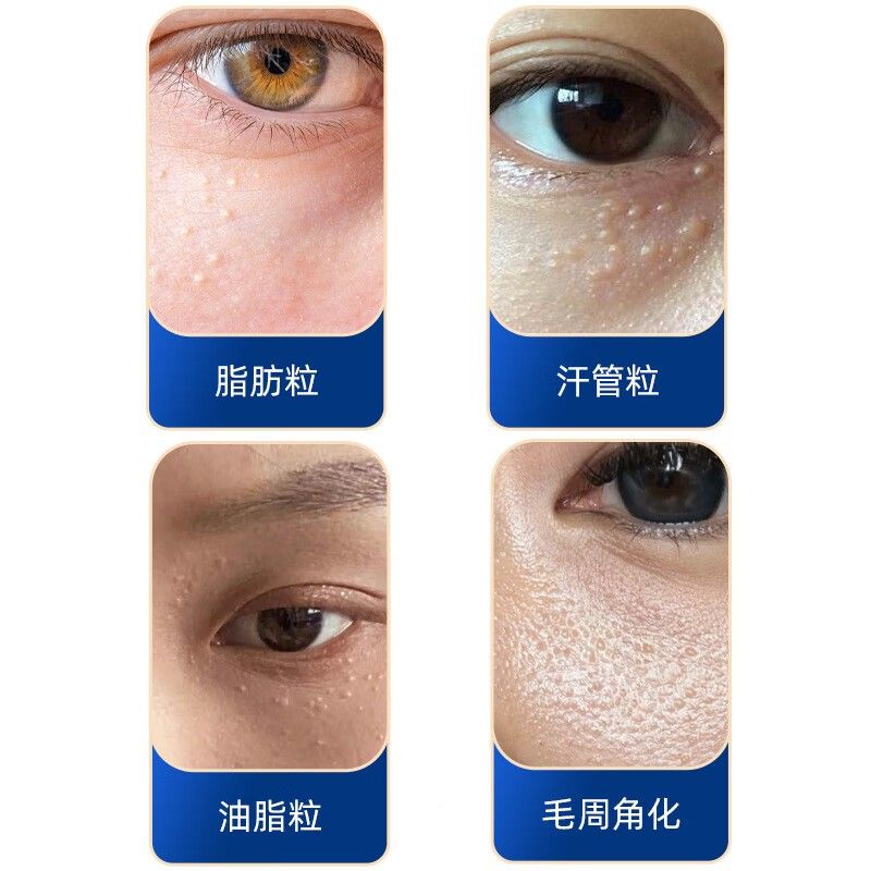 云南本颗颗周粒清肌膏紧致WXK眼去脂肪油脂粒汗管瘤粉刺闭口正草