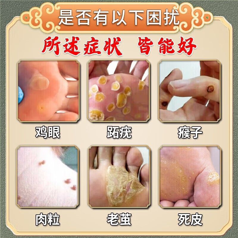 云南草本鸡贴眼膏根无去肉刺脱落痛连根i拔专刺猴i用CSG除硬块老