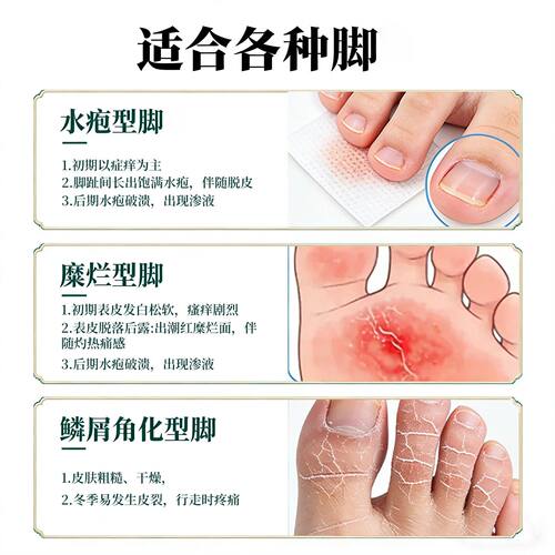 医用用液碘伏消毒高浓专度泡脚出汗臭克星止脱皮痒杀OBY菌真菌感