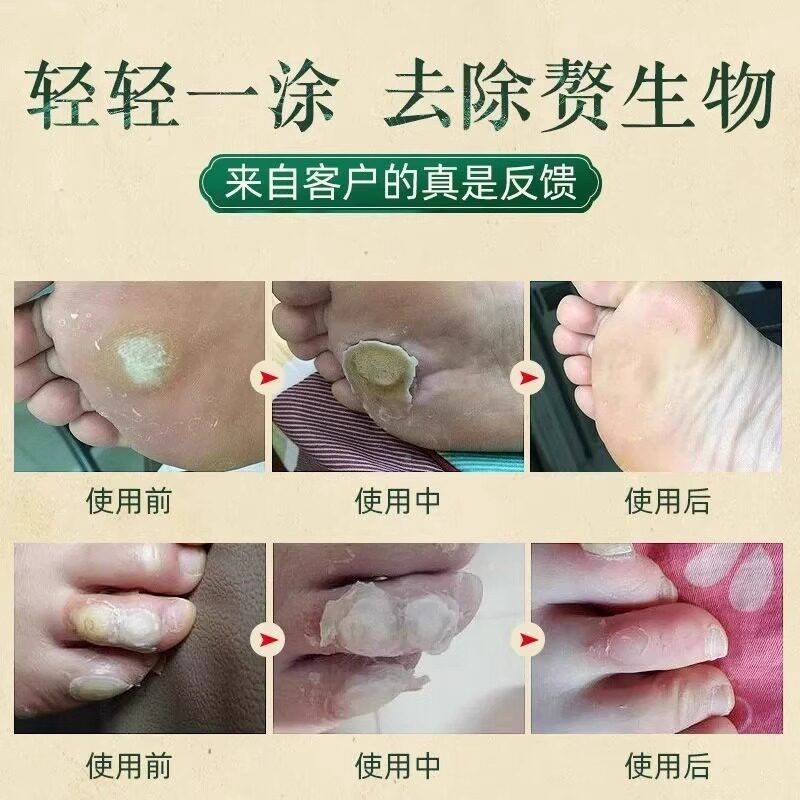 修正清皮肤抑菌液老茧去化茧死脚茧硬皮死皮手足WRA旗官灵方舰店