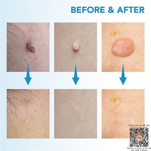 Skin Tag Remover Skin Tag Removal Device Skin Tags祛工具