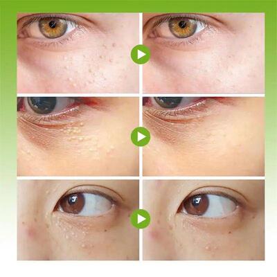 Fat Granules Remover Eye Cream Effective Remove Fat Granules