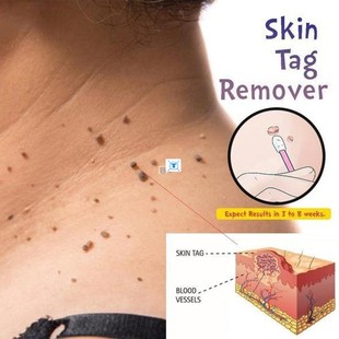 Skin Tag Mole Wart Remover Eye Skin Tag Remover 12 Hours