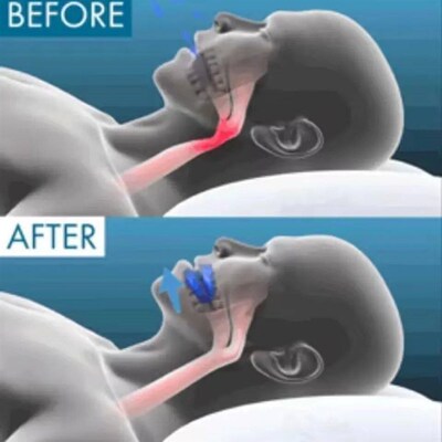 Anti Snoring Mouthpiece Sleeping Devices Anti Snore Mouth Gu