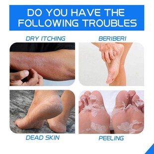 Ximonth Heel Repair Cream prevents and repairs dry, cracked