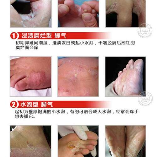 Foot Cream Feet Care For Athletes Foot,Blisters,Peeling Fe