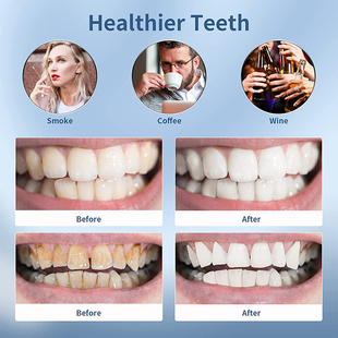 Electric Sonic Dental Calculus Scaler Oral Teeth Tartar Remo