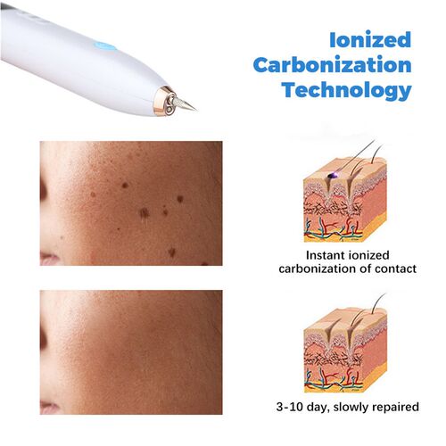 Skin Tag Remover Warts Eliminator Lcd Plasma Pen Papillomas