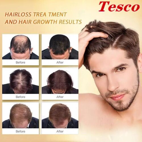 35ml Ginger Hair care Growth Essential Oil Prevent Loss Hair
